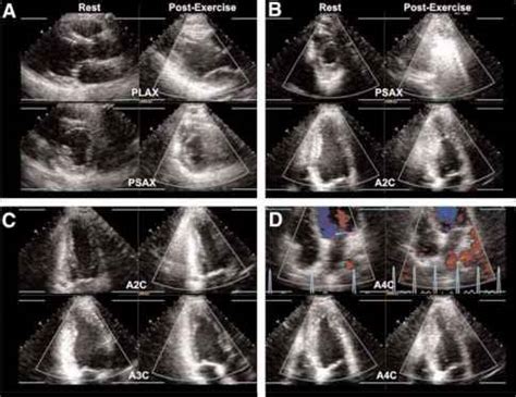 basal inferior wall hypokinesis symptoms.